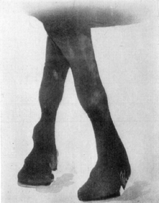 Fig. 29—Distension of theca of the extensor of the digit (extensor pedis). Fig. 29—Distension of theca of the extensor of the digit (extensor pedis).