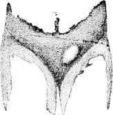 rupture, stage 2 rupture, stage 2