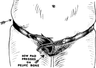 'How pad presses on pelvic bone' 'How pad presses on pelvic bone'