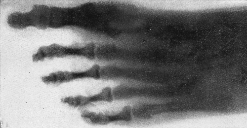 BONES OF A HUMAN FOOT PHOTOGRAPHED THROUGH THE FLESH BONES OF A HUMAN FOOT PHOTOGRAPHED THROUGH THE FLESH