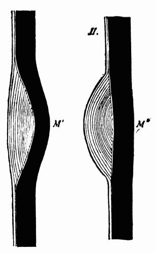 Fig. 8.—I, media weakened at M' with overgrowth of intima filling in the depression. II, with postmortem rigor and contraction of the muscles of the media and removal of the blood pressure from within, the stretched media at M'' contracts; the intimal thickening thus projects into the arterial lumen. (After Adami.) Fig. 8.—I, media weakened at M' with overgrowth of intima filling in the depression. II, with postmortem rigor and contraction of the muscles of the media and removal of the blood pressure from within, the stretched media at M'' contracts; the intimal thickening thus projects into the arterial lumen. (After Adami.)