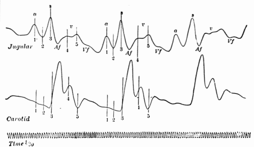 Fig. 36.—Simultaneous tracings of the jugular and carotid pulses showing normal waves in the venous pulse and relation to carotid pulse. (After Bachmann.) Fig. 36.—Simultaneous tracings of the jugular and carotid pulses showing normal waves in the venous pulse and relation to carotid pulse. (After Bachmann.)